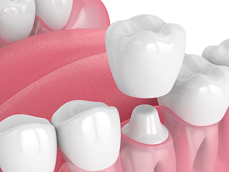 The image displays a collection of artificial teeth, with a variety of shapes, sizes, and colors, set against a pink background that resembles gum tissue, suggesting a dental care or dental implant context.